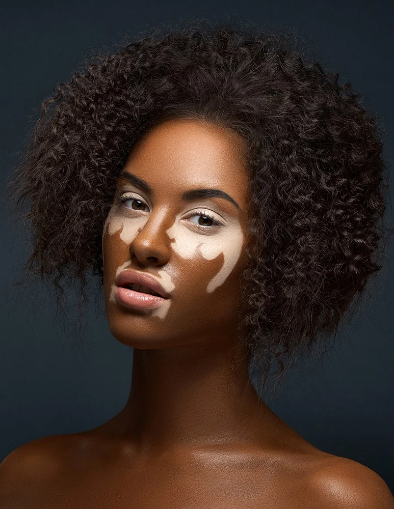 Vitiligo